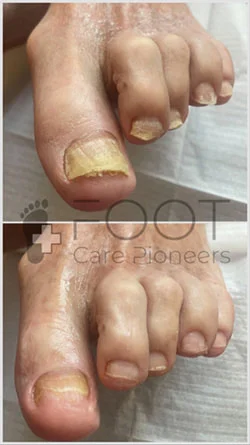 Очищення зроговілих нігтів подолог Вири.