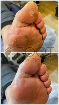 Видалення твердої шкіри подологом у Руді Шльонській.