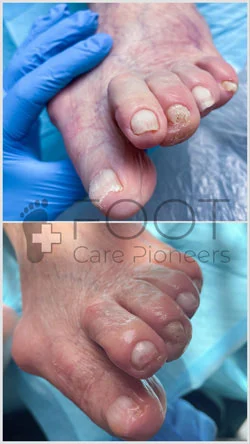 Скорочення товстих нігтів у сеньйора. Подолог Бринув.